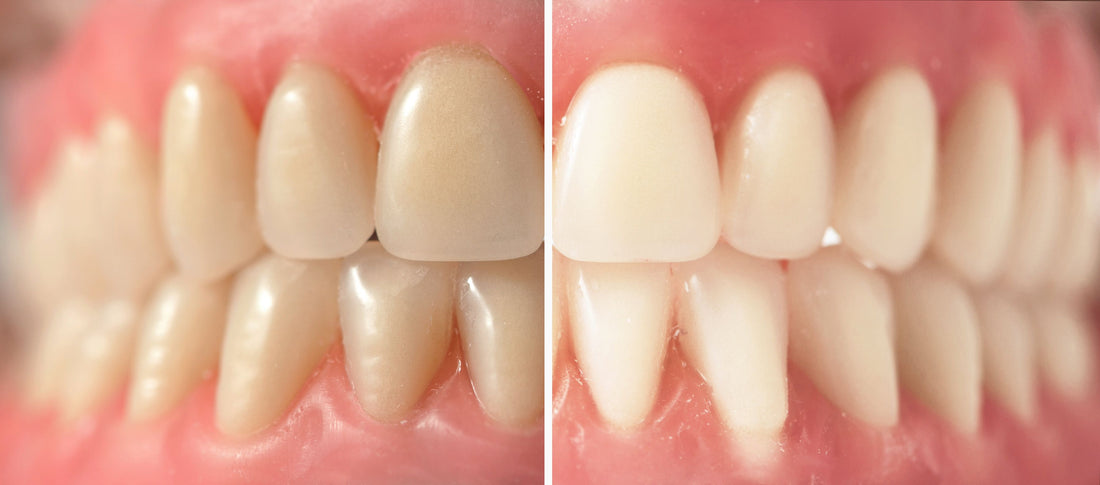 Does coconut oil pulling whiten teeth? - PRANA Beauty & Wellness