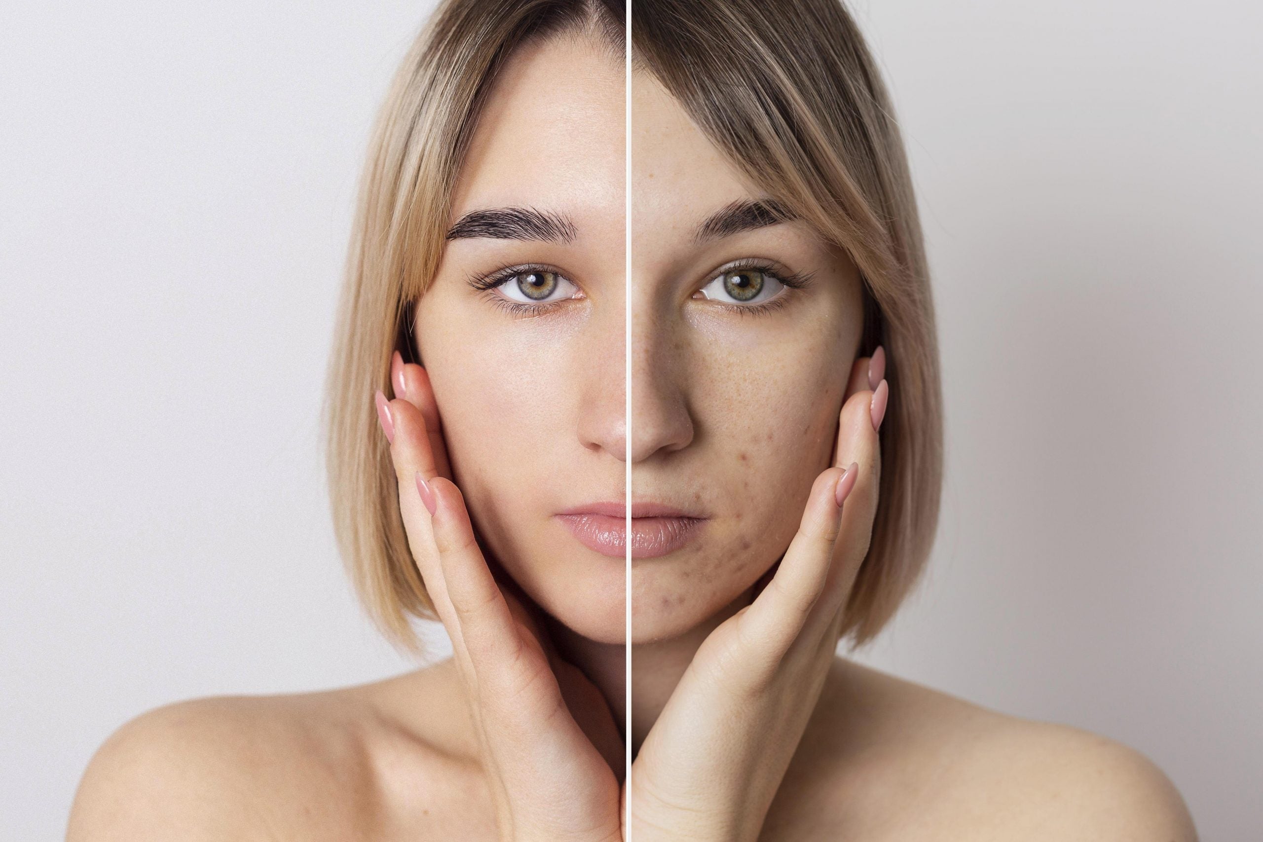 How to cure acne naturally in 3 days? - PRANA Beauty & Wellness