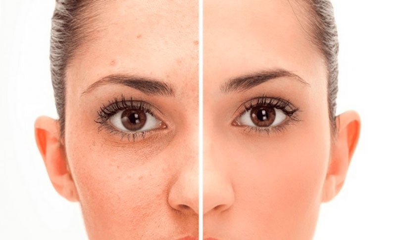 How to get clear skin? - PRANA Beauty & Wellness
