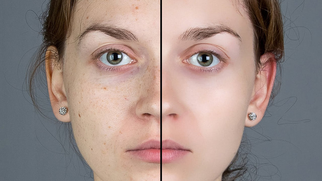How to get fiberglass out of skin? - PRANA Beauty & Wellness